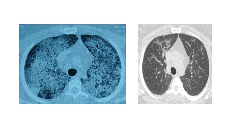Akciğerlerde yağ birikmesine akciğer yıkama ile çözüm Akciğerlerde yağ birikmesine akciğer yıkama ile çözüm