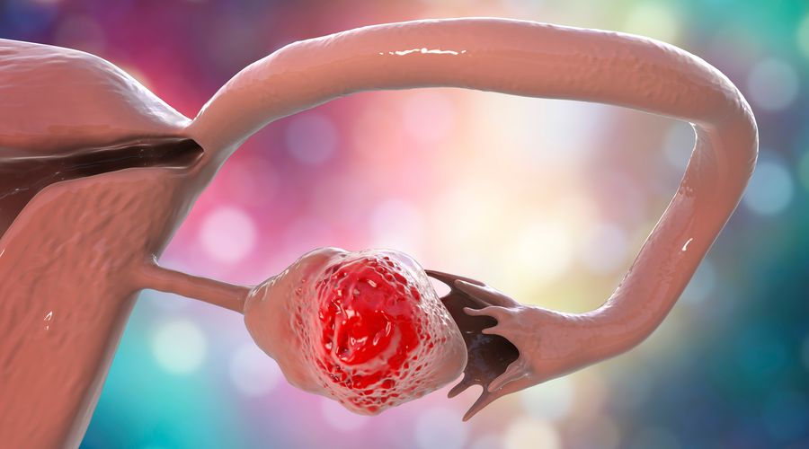 Yumurtalık kanseri riskini ölçen algoritma geliştirildi: Cerrahi menopozu öteleyebilir Yumurtalık kanseri riskini ölçen algoritma geliştirildi: Cerrahi menopozu öteleyebilir